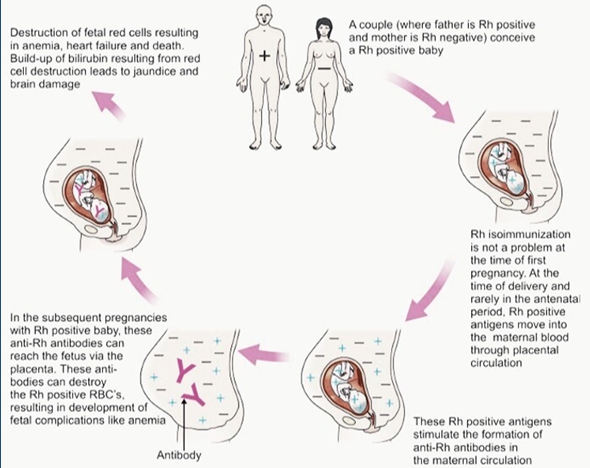 Eritroblastosis fetalis dapat terjadi pada janin apabila